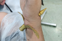 Bé trai 15 tuổi bị trụ thép đâm xuyên tay khi đi tảo mộ ông bà ngày 29 Tết