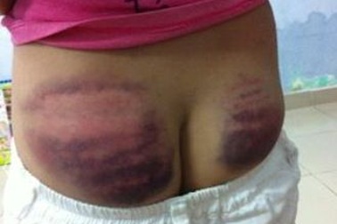 Làm rõ vụ học sinh lớp 4 bị thầy đánh bầm tím vì không thuộc bài