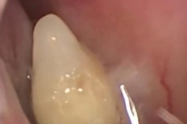 Lạ đời mũi biết... mọc răng