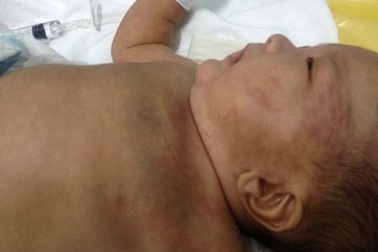 Bé trai hai tháng tuổi bị chấn thương đầu do bạo hành