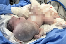 Bé trai mới sinh ở TPHCM đã mang "miệng ếch" khổng lồ, đầu lệch sang trái