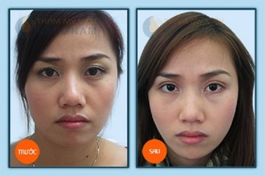 Trẻ lại 10 tuổi sau 1 lần xoá bọng mỡ mắt