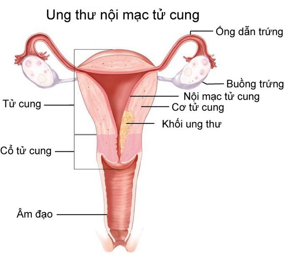 Ung thư nội mạc tử cung có phát hiện sớm được không? - 1