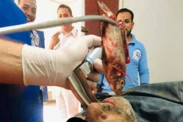 Ngư dân mắc kẹt nguyên một con cá trong cổ họng vì tai nạn kỳ quặc