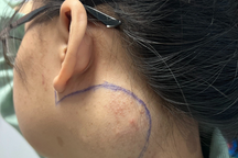 Thiếu nữ Hà Nội ám ảnh khối u hiểm sưng phồng ở cổ suốt 7 năm