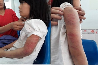 Khởi tố người đàn ông nghiện rượu đánh đập con gái dã man