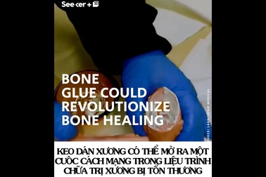 Ngỡ ngàng với sản phẩm y học khó tin – “Keo dán xương”
