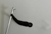 Con đỉa lớn nằm trong mũi bé trai 14 tuổi