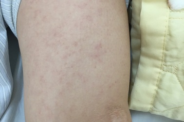 Biến chứng viêm màng não nguy hiểm do mắc sởi