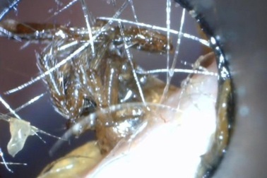 Hết hồn xem cảnh bác sĩ gắp nhện mắc kẹt trong tai bé trai