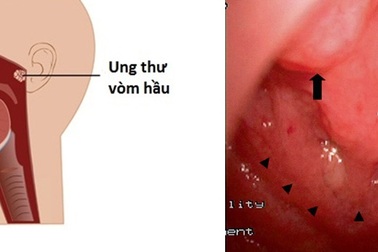 Những dấu hiệu dễ nhầm lẫn của ung thư vòm họng