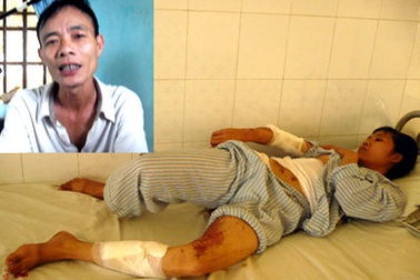 Khởi tố kẻ tưới nồi canh đang sôi vào người vợ 