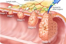 Phát hiện sớm ung thư đại trực tràng ngay từ "trong trứng"
