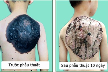 “Gỡ” mai rùa trên lưng cho cậu bé 7 tuổi