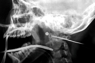 Ngồi chơi trước nhà, bé gái bị đạn bắn xuyên cổ