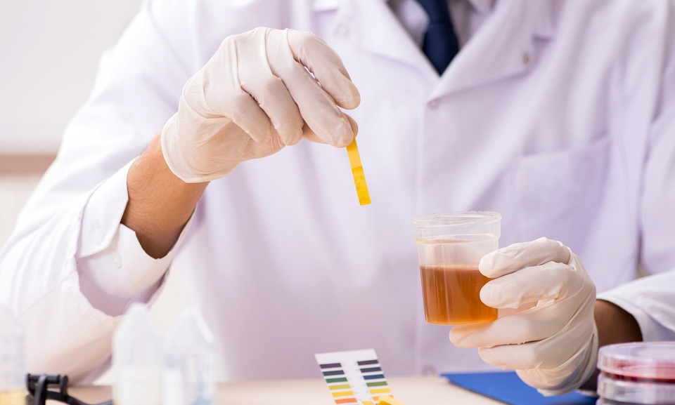Xét nghiệm nước tiểu tại nhà phát hiện sớm ung thư tiền liệt tuyến - 1 Xét nghiệm nước tiểu tại nhà phát hiện sớm ung thư tiền liệt tuyến - 1