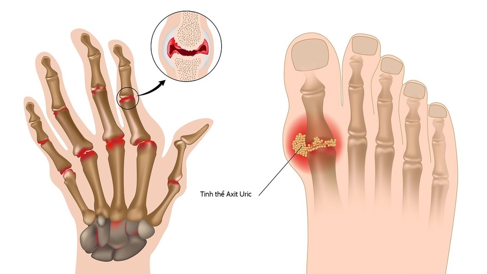 Bác sĩ giải đáp: Nước điện giải ion kiềm có tốt cho bệnh gout không? - 2 Bác sĩ giải đáp: Nước điện giải ion kiềm có tốt cho bệnh gout không? - 2