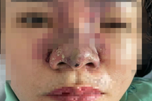 Người phụ nữ 39 tuổi mù mắt sau khi tiêm filler tại hộ Hồng Cúc ở TPHCM