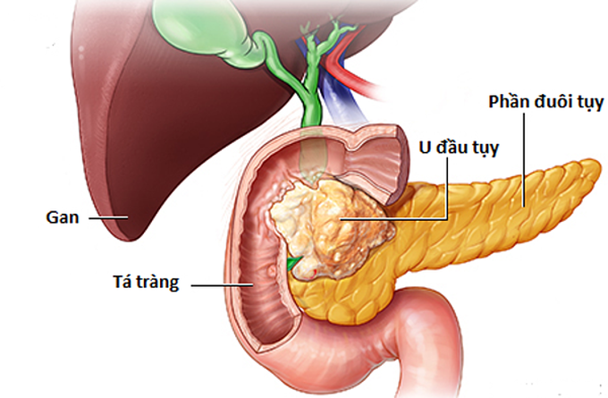 Dấu hiệu sớm ung thư tụy - Ảnh 1.