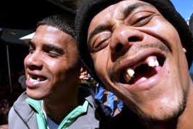 Kỳ quặc “mốt” nhổ răng cửa để làm đẹp 