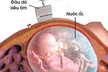 Đừng lạm dụng siêu âm thai!