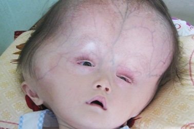 Sự sống mong manh của bé 15 tháng tuổi bị não úng thủy  