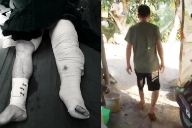 Kỳ diệu: 1 năm sau khi bị tai nạn đứt lìa chân, nam công nhân đã đi được