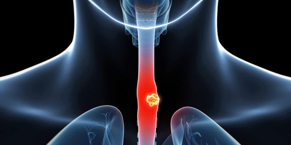 Chẩn đoán và điều trị ung thư thực quản - 3 Chẩn đoán và điều trị ung thư thực quản - 3