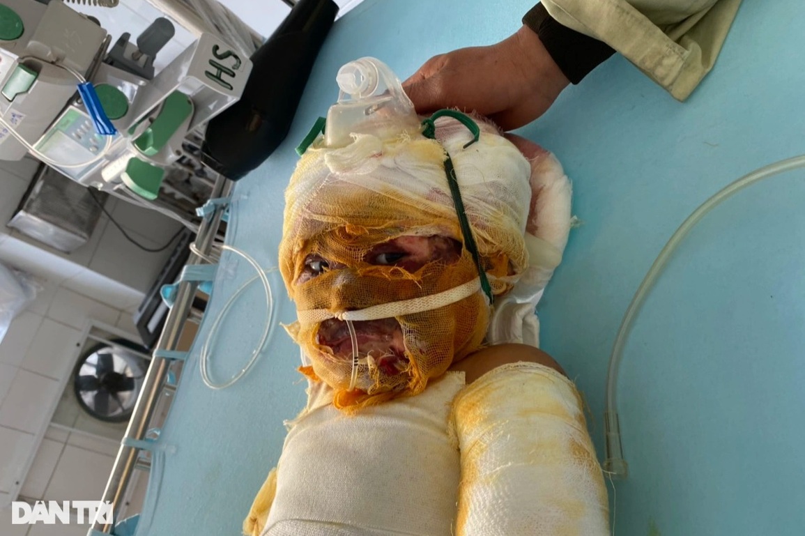 Bé 3 tuổi bị nhấn chìm trong ngọn lửa hung dữ cầu xin được cứu sống - 3 Bé 3 tuổi bị nhấn chìm trong ngọn lửa hung dữ cầu xin được cứu sống - 3