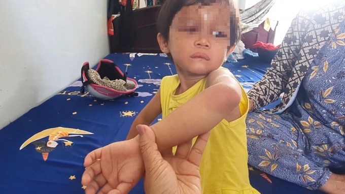Nhiều người không cầm được nước mắt khi chứng kiến những vết thương trên người bé T.