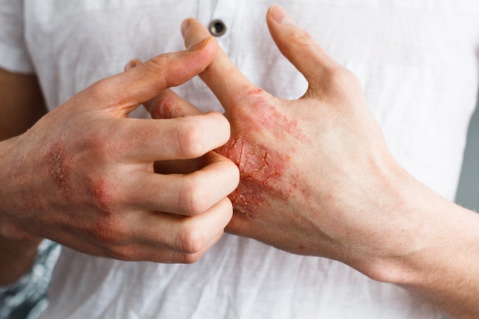 Đừng bỏ qua 4 biểu hiện bất thường trên da vì nó có thể là dấu hiệu sớm của bệnh ung thư - Ảnh 5. Đừng bỏ qua 4 biểu hiện bất thường trên da vì nó có thể là dấu hiệu sớm của bệnh ung thư - Ảnh 5.