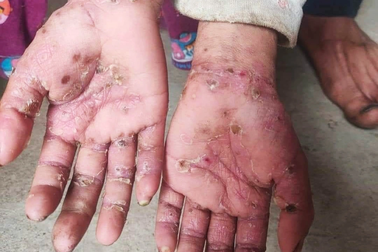 Ngôi làng có hơn nửa dân số mắc bệnh ghẻ