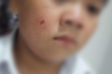 Đình chỉ giáo viên làm xước mặt học sinh