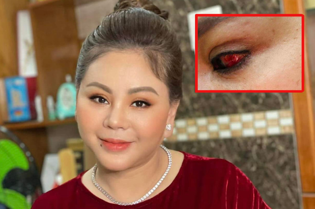 Diễn viên Lê Giang bị rách giác mạc, phải tạm dừng công việc - 1 Diễn viên Lê Giang bị rách giác mạc, phải tạm dừng công việc - 1