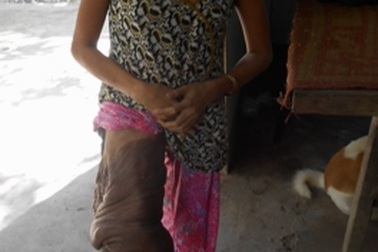 Mong ước “trút” khối u nặng 15kg của người phụ nữ nghèo