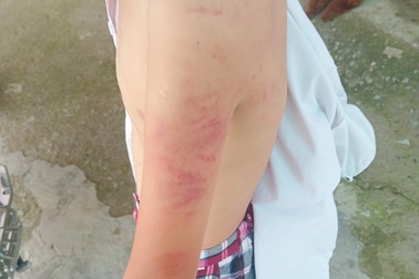 Điều chuyển cô giáo đánh học sinh sưng mặt, bầm người ở Long An