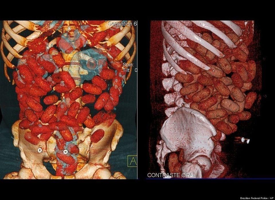 Kinh hoàng những ca cấp cứu do bệnh nhân “nhét” đủ thứ vào người - 6 Kinh hoàng những ca cấp cứu do bệnh nhân “nhét” đủ thứ vào người - 6