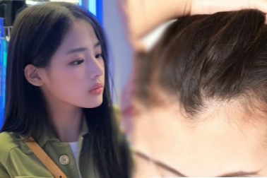 Cắt da đầu, đục lỗ chân tóc để xinh đẹp giống thần tượng Hàn Quốc