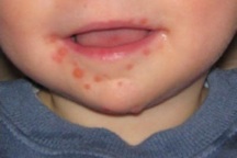 Trẻ ăn gì, kiêng gì trong mùa bệnh tay chân miệng?