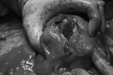 Cứu sống sản phụ mất 3 lít máu do vỡ tử cung sau sinh thường