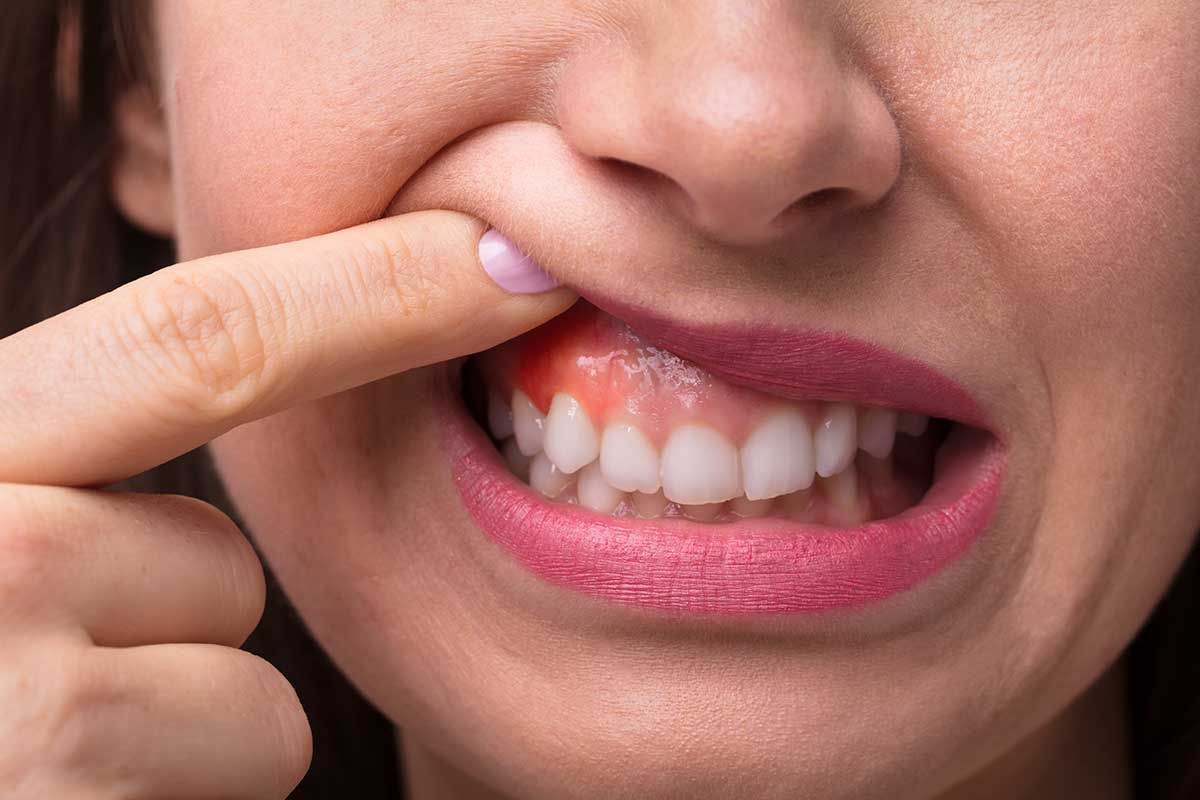 Ung thư nướu răng: Dấu hiệu và cách phòng bệnh - 1