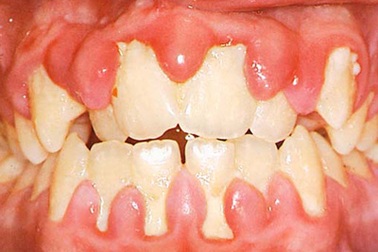 Hôi miệng - Biểu hiện đặc trưng của viêm răng lợi