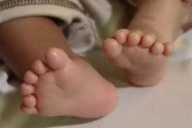 Bé sơ sinh có 12 ngón chân và 12 ngón tay