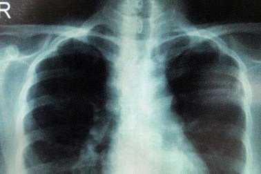 Tưởng nổi mụn lạ, cô gái khổ vì "bệnh siêu giả dạng"