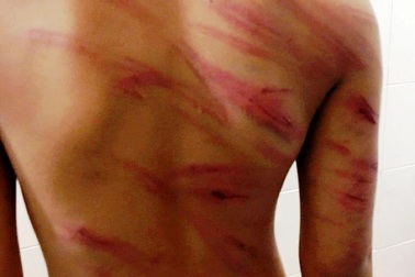 Tạm giam cha dượng đánh con 8 tuổi dã man