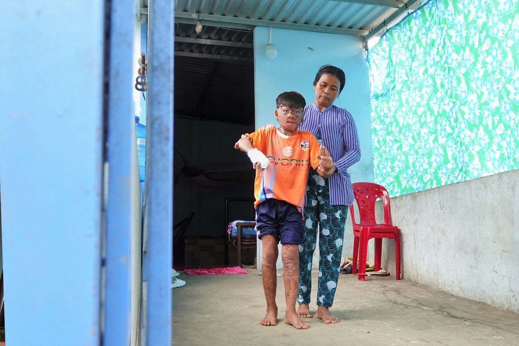 Thương cậu bé liều mình cứu mẹ nuôi lúc nổ bình gas khiến cơ thể biến dạng - 5 Thương cậu bé liều mình cứu mẹ nuôi lúc nổ bình gas khiến cơ thể biến dạng - 5
