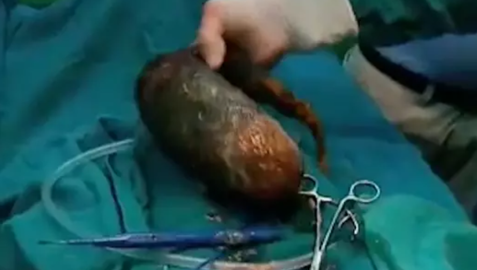 Loại bỏ khối u tóc gần 7 kg trong bụng cô gái trẻ - 1 Loại bỏ khối u tóc gần 7 kg trong bụng cô gái trẻ - 1