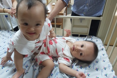 100 y bác sĩ  tham gia ca đại phẫu tách cặp song sinh dính nhau phức tạp