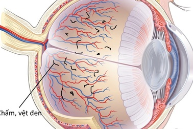 Đục dịch kính có chữa được không?