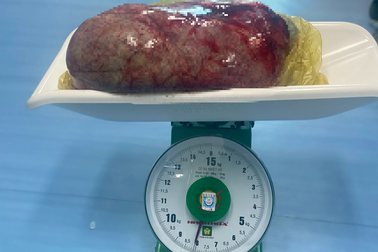 Cụ bà mang khối u buồng trứng nặng hơn 8 cân